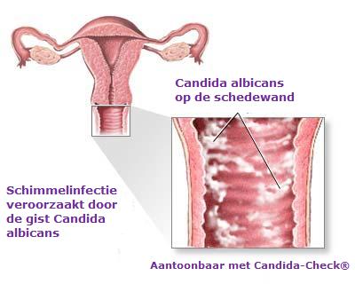 Vaginale Candida Albicans Schimmelinfectie